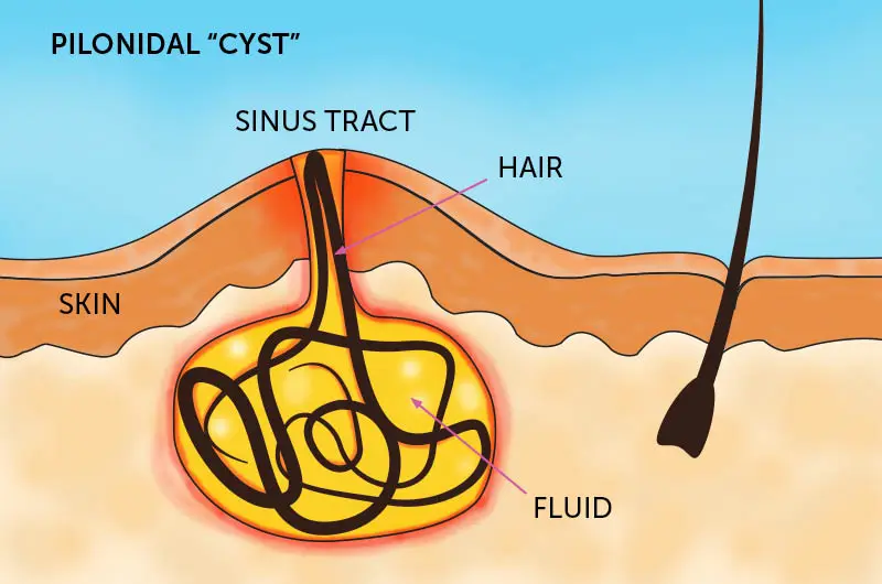 Get treatment from Pilonidal Sinus Laser Specialist in Bandha Chhada