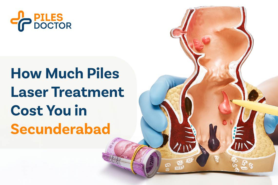Piles Laser Treatment Cost in Secunderabad