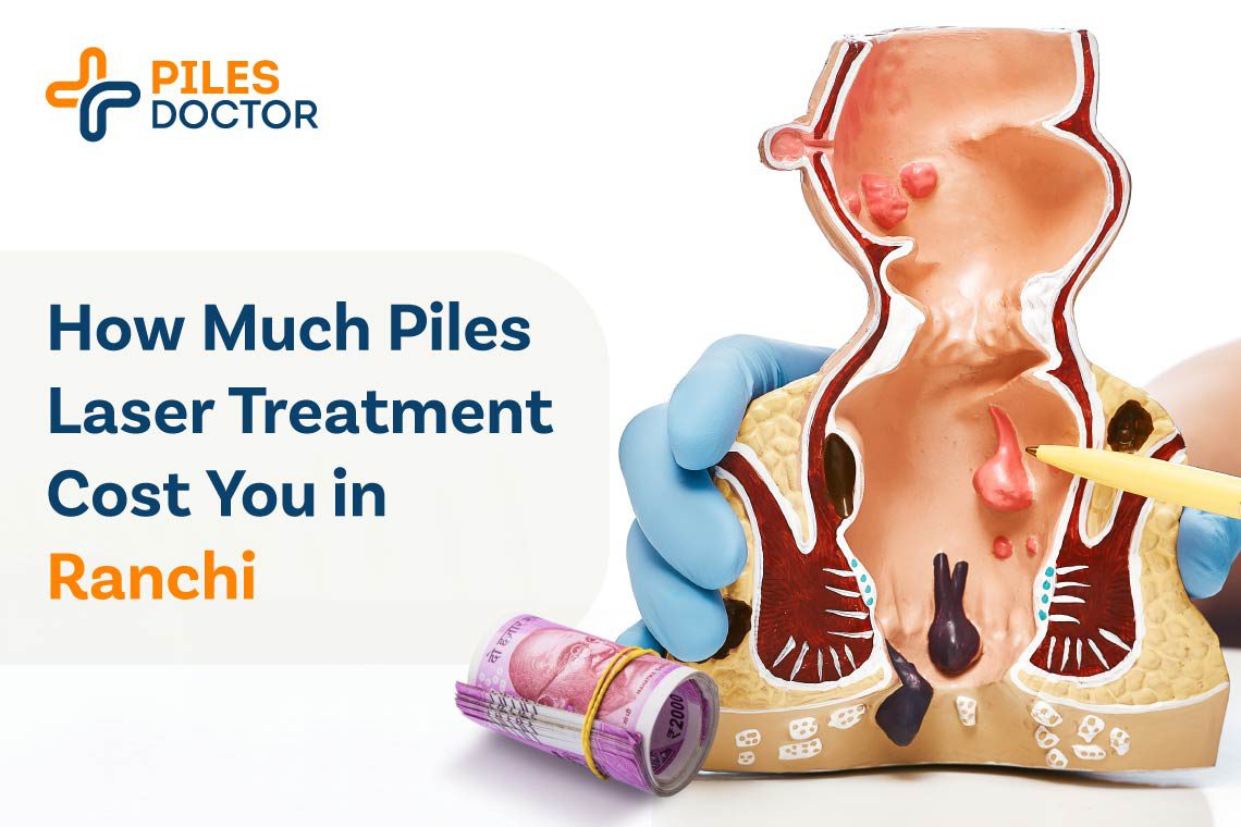 Piles Laser Treatment in Ranchi
