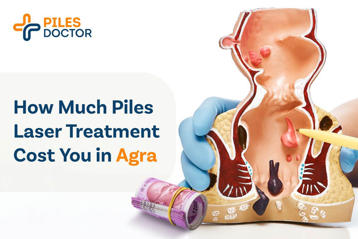 Piles Laser Treatment in Agra