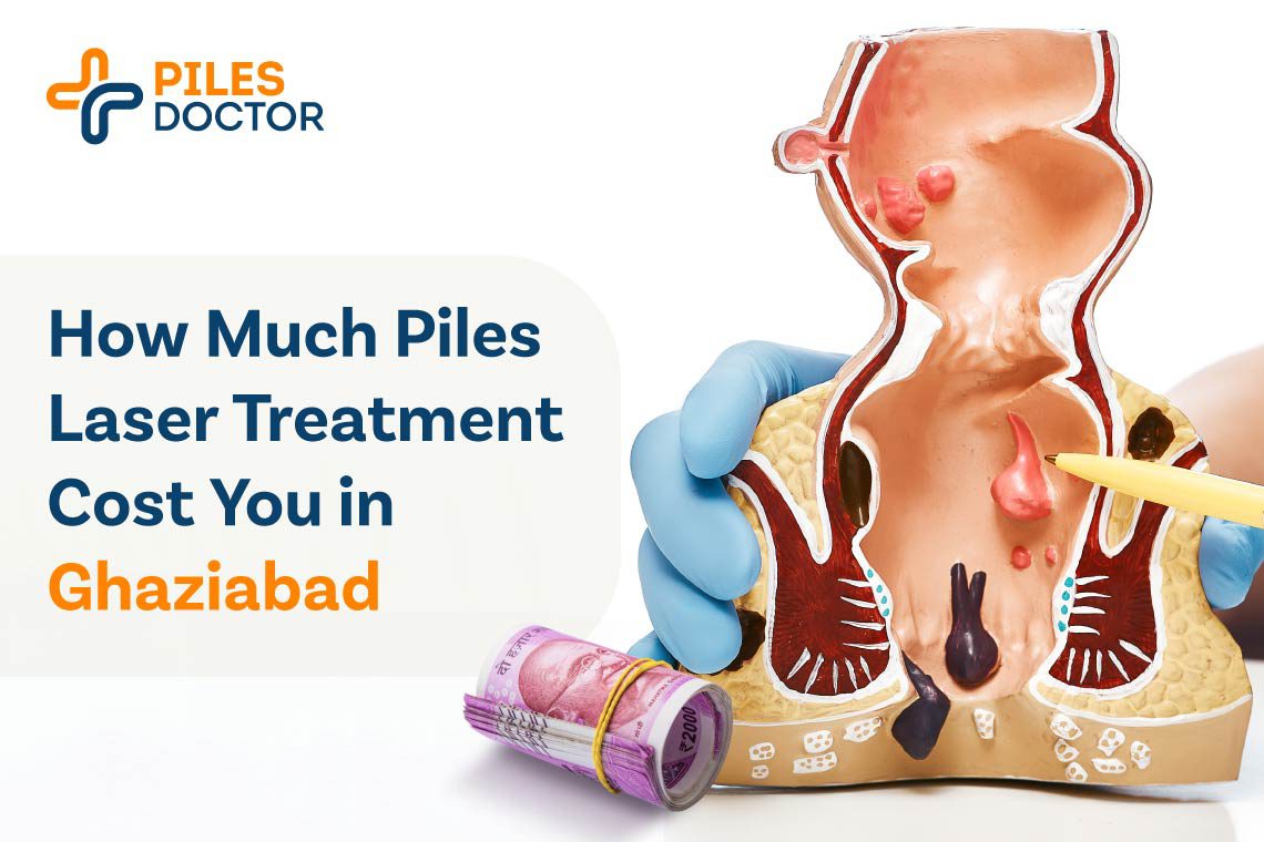 Piles Laser Treatment Cost in Ghaziabad