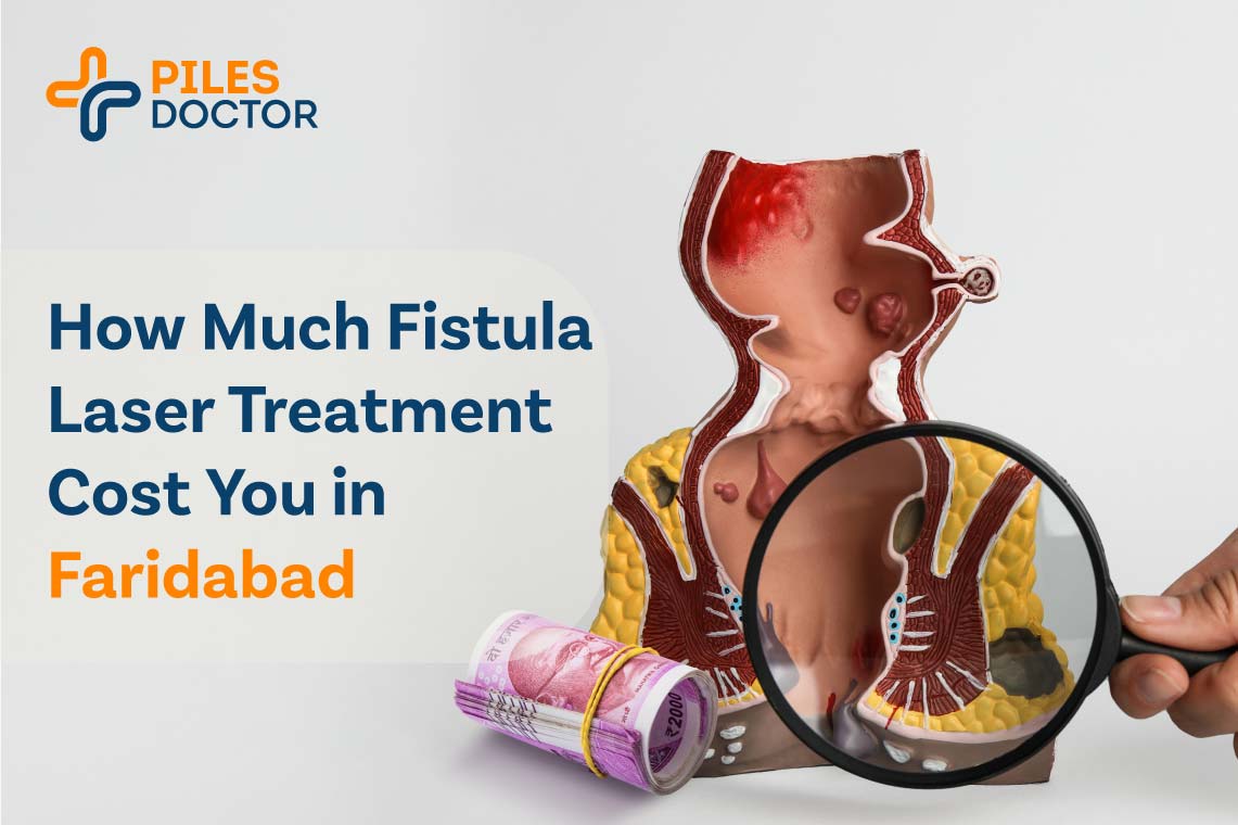 Fistula Surgery Cost in Faridabad