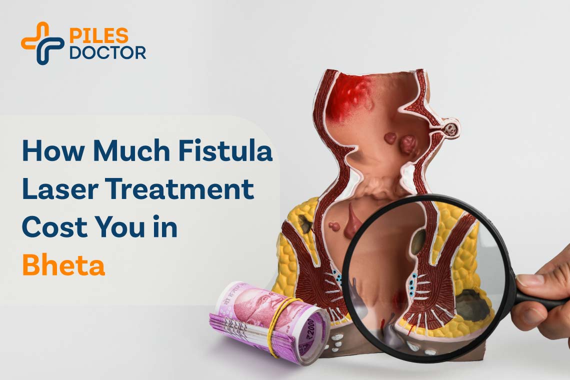 fistula laser treatment cost in bheta