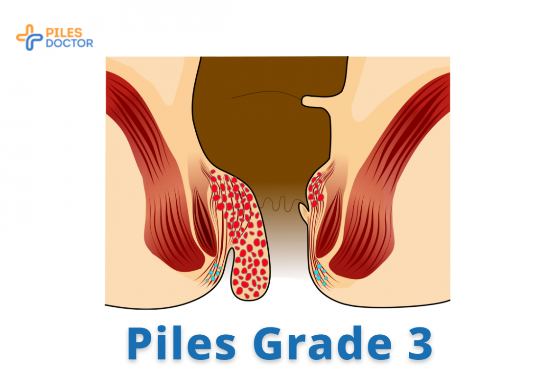 Grade 3 Piles