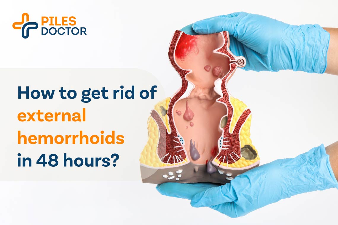 How to get rid of external hemorrhoids in 48 hours