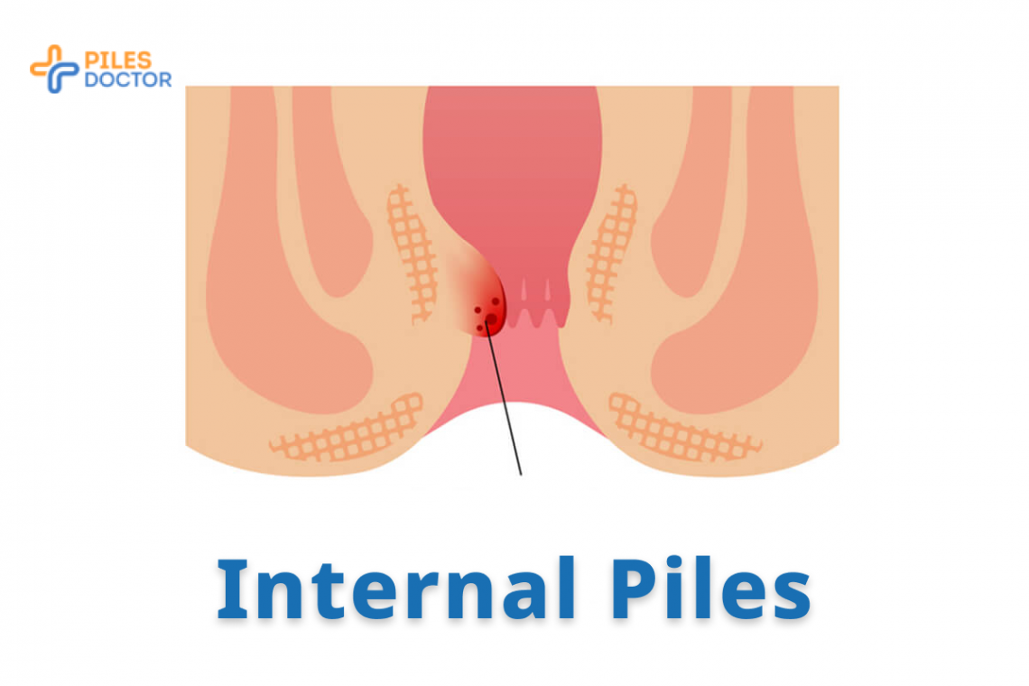 Internal Piles Treatment