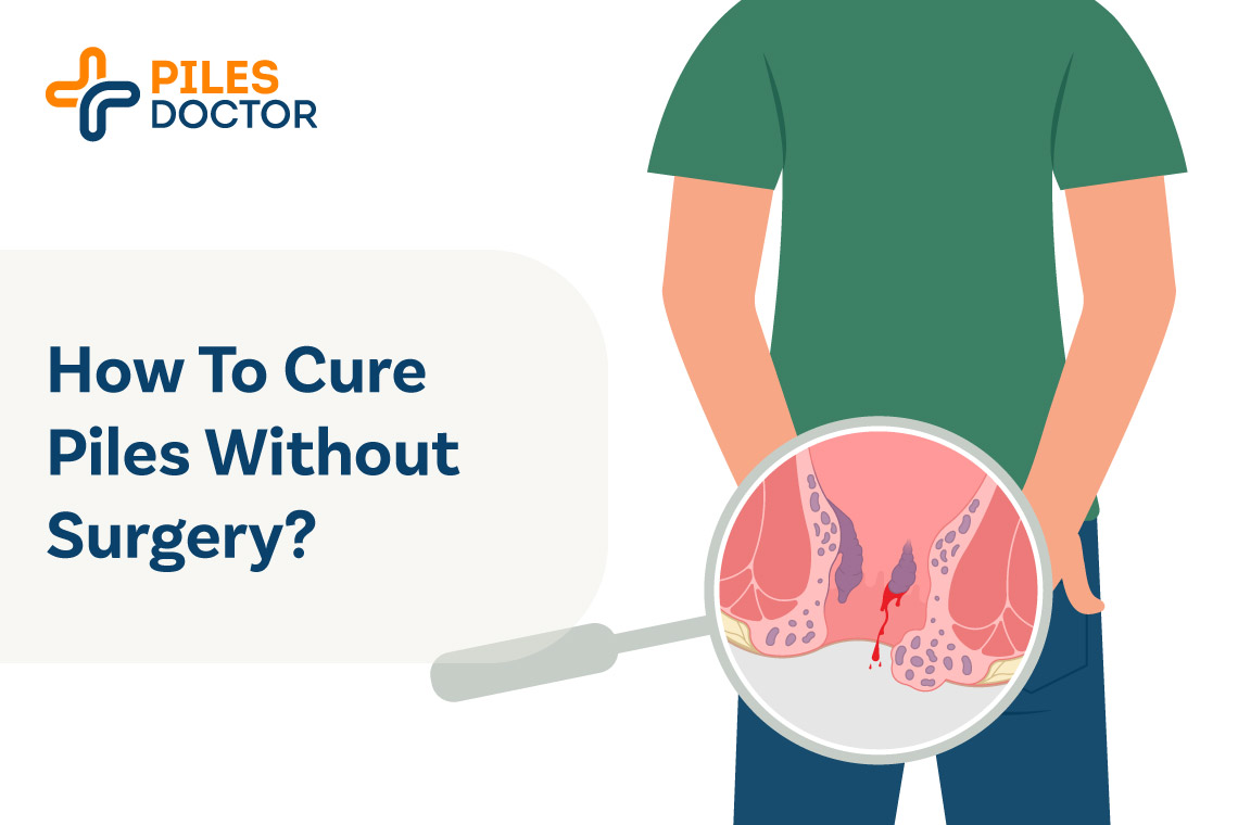 How to cure piles without surgery